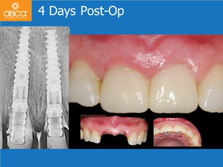 Immediate Implants of the 2 Upper Central Incisors with Immediate Load
