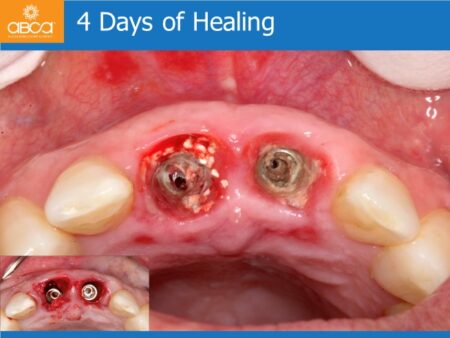 Immediate Implants of the 2 Upper Central Incisors with Immediate Load