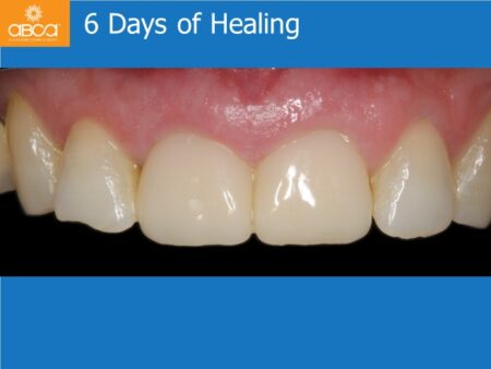 Immediate Implants of the 2 Upper Central Incisors with Immediate Load