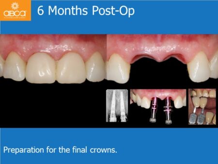 Immediate Implants of the 2 Upper Central Incisors with Immediate Load