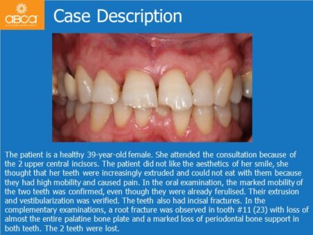 Immediate Implants of the 2 Upper Central Incisors with Immediate Load