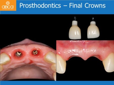 Immediate Implants of the 2 Upper Central Incisors with Immediate Load