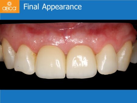 Immediate Implants of the 2 Upper Central Incisors with Immediate Load