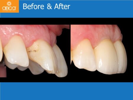 Immediate Implants of the 2 Upper Central Incisors with Immediate Load