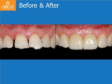 Immediate Implants of the 2 Upper Central Incisors with Immediate Load