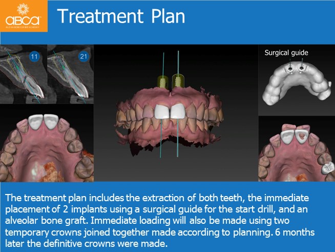 Immediate Implants of the 2 Upper Central Incisors with Immediate Load