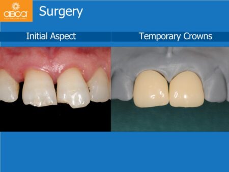 Immediate Implants of the 2 Upper Central Incisors with Immediate Load