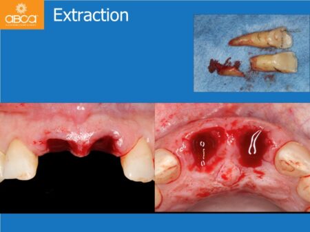 Immediate Implants of the 2 Upper Central Incisors with Immediate Load