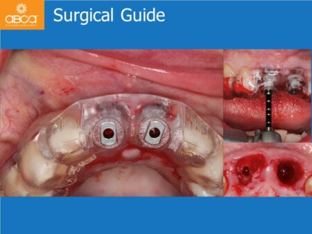 Immediate Implants of the 2 Upper Central Incisors with Immediate Load