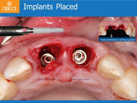 Immediate Implants of the 2 Upper Central Incisors with Immediate Load