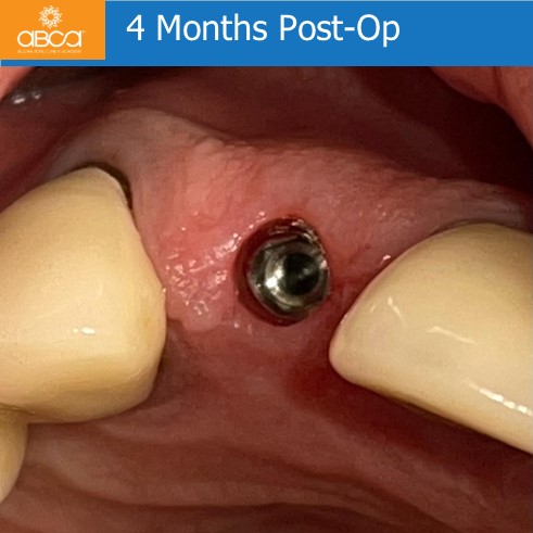 Right Max Lateral PET, Augma and Implant