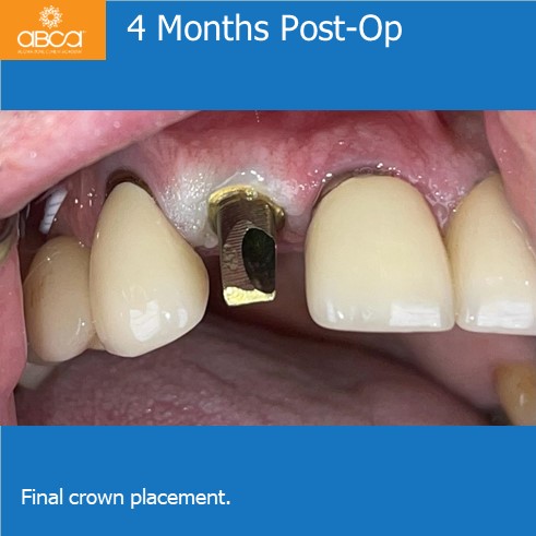 Right Max Lateral PET, Augma and Implant