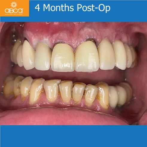 Right Max Lateral PET, Augma and Implant