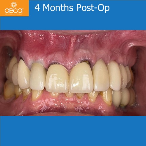 Right Max Lateral PET, Augma and Implant