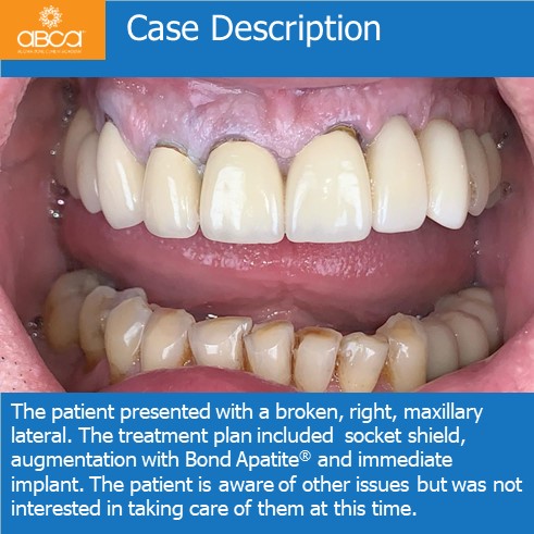 Right Max Lateral PET, Augma and Implant