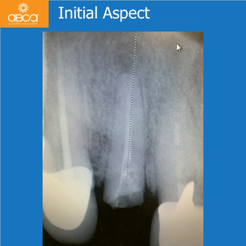 Right Max Lateral PET, Augma and Implant
