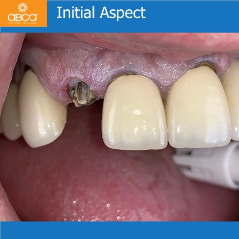 Right Max Lateral PET, Augma and Implant