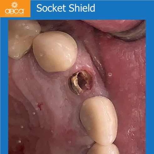 Right Max Lateral PET, Augma and Implant
