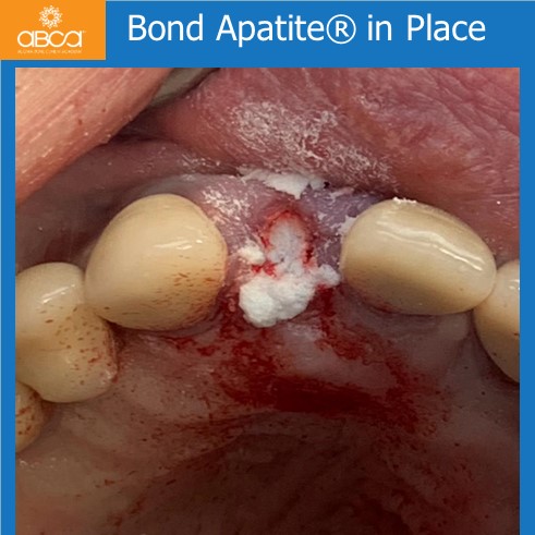Right Max Lateral PET, Augma and Implant