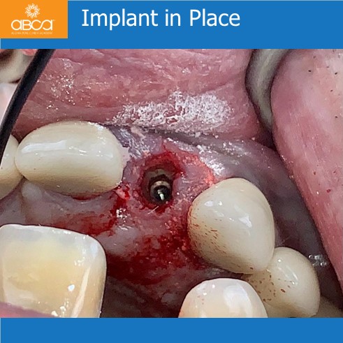 Right Max Lateral PET, Augma and Implant