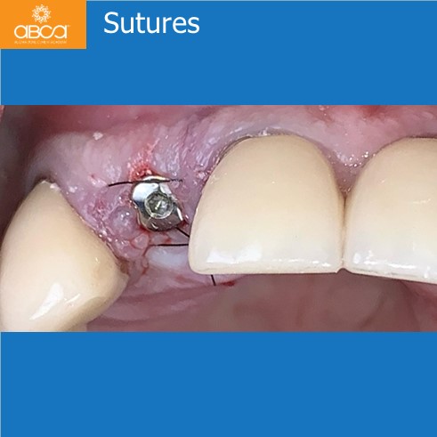Right Max Lateral PET, Augma and Implant