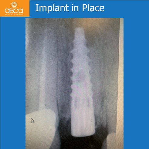 Right Max Lateral PET, Augma and Implant
