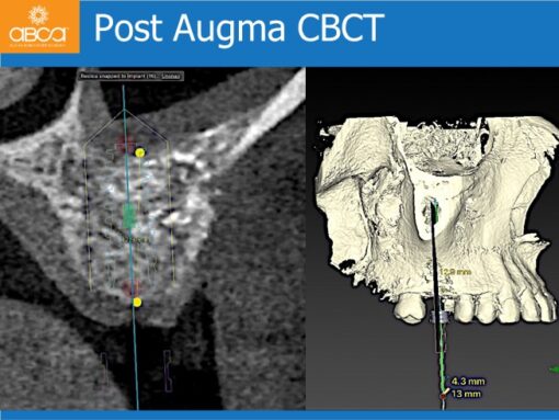 Sinus Lift with Augma Bone Cement