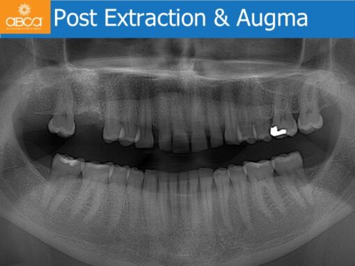 Sinus Lift with Augma Bone Cement