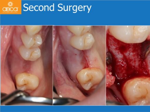 Sinus Lift with Augma Bone Cement
