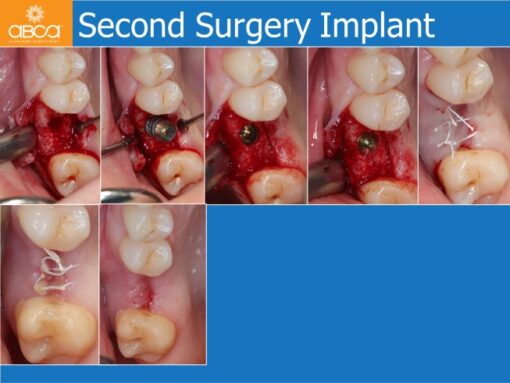 Sinus Lift with Augma Bone Cement