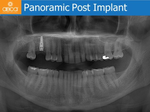 Sinus Lift with Augma Bone Cement