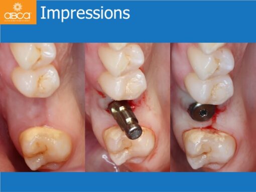 Sinus Lift with Augma Bone Cement