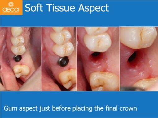 Sinus Lift with Augma Bone Cement