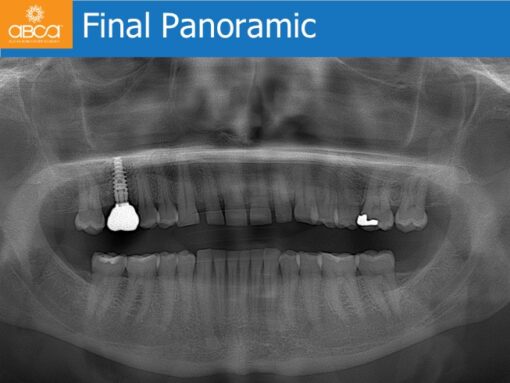 Sinus Lift with Augma Bone Cement
