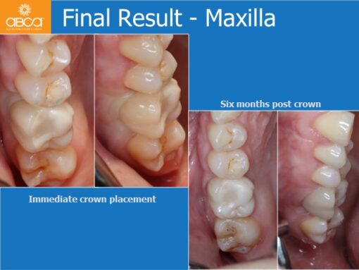 Sinus Lift with Augma Bone Cement