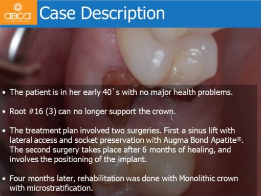 Sinus Lift with Augma Bone Cement