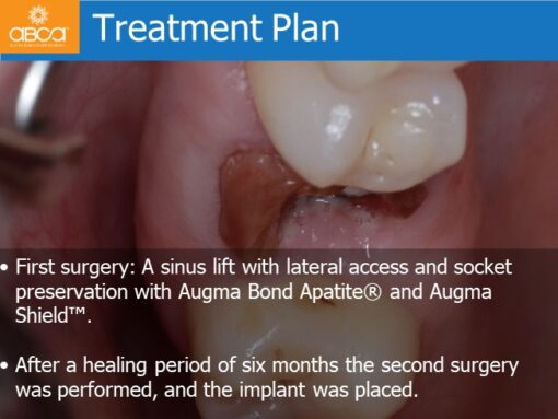 Sinus Lift with Augma Bone Cement