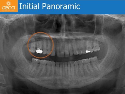 Sinus Lift with Augma Bone Cement