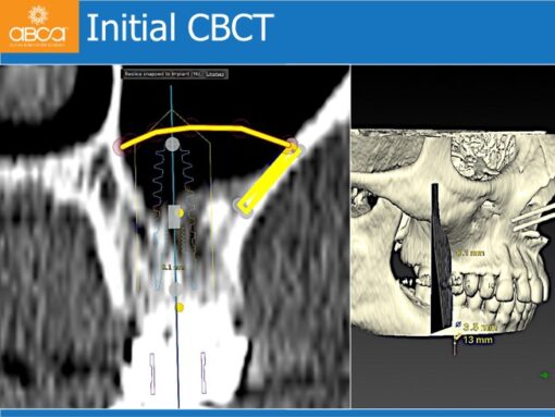 Sinus Lift with Augma Bone Cement
