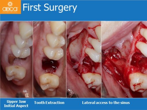 Sinus Lift with Augma Bone Cement