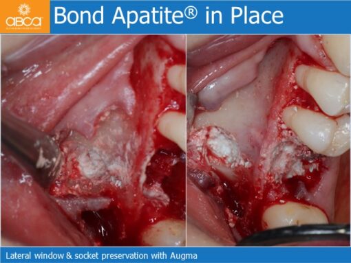 Sinus Lift with Augma Bone Cement