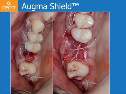 Sinus Lift with Augma Bone Cement