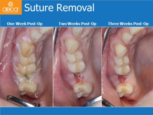Sinus Lift with Augma Bone Cement