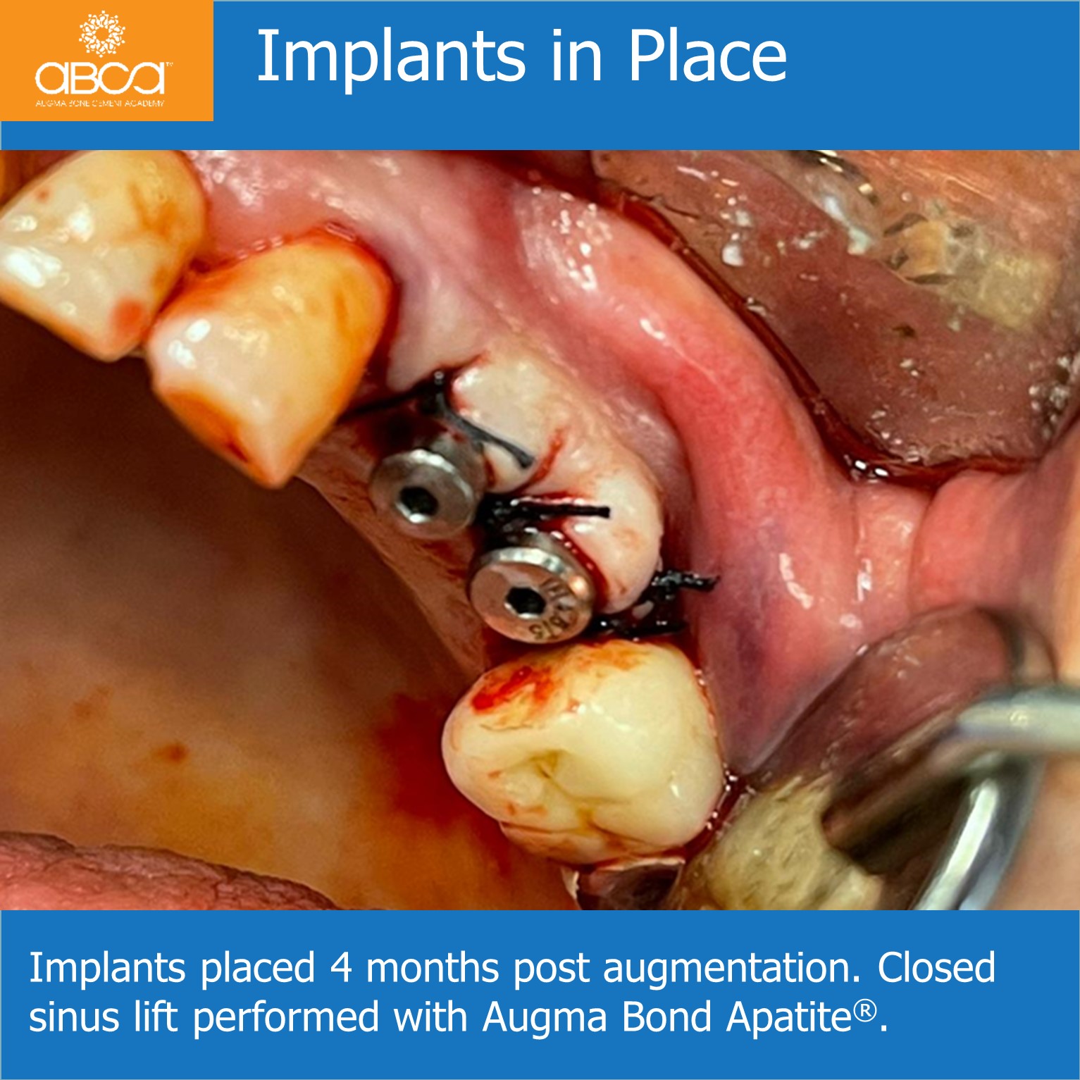 Implants in Place - Implants placed 4 months post augmentation. Closed sinus lift performed with Augma Bond Apatite