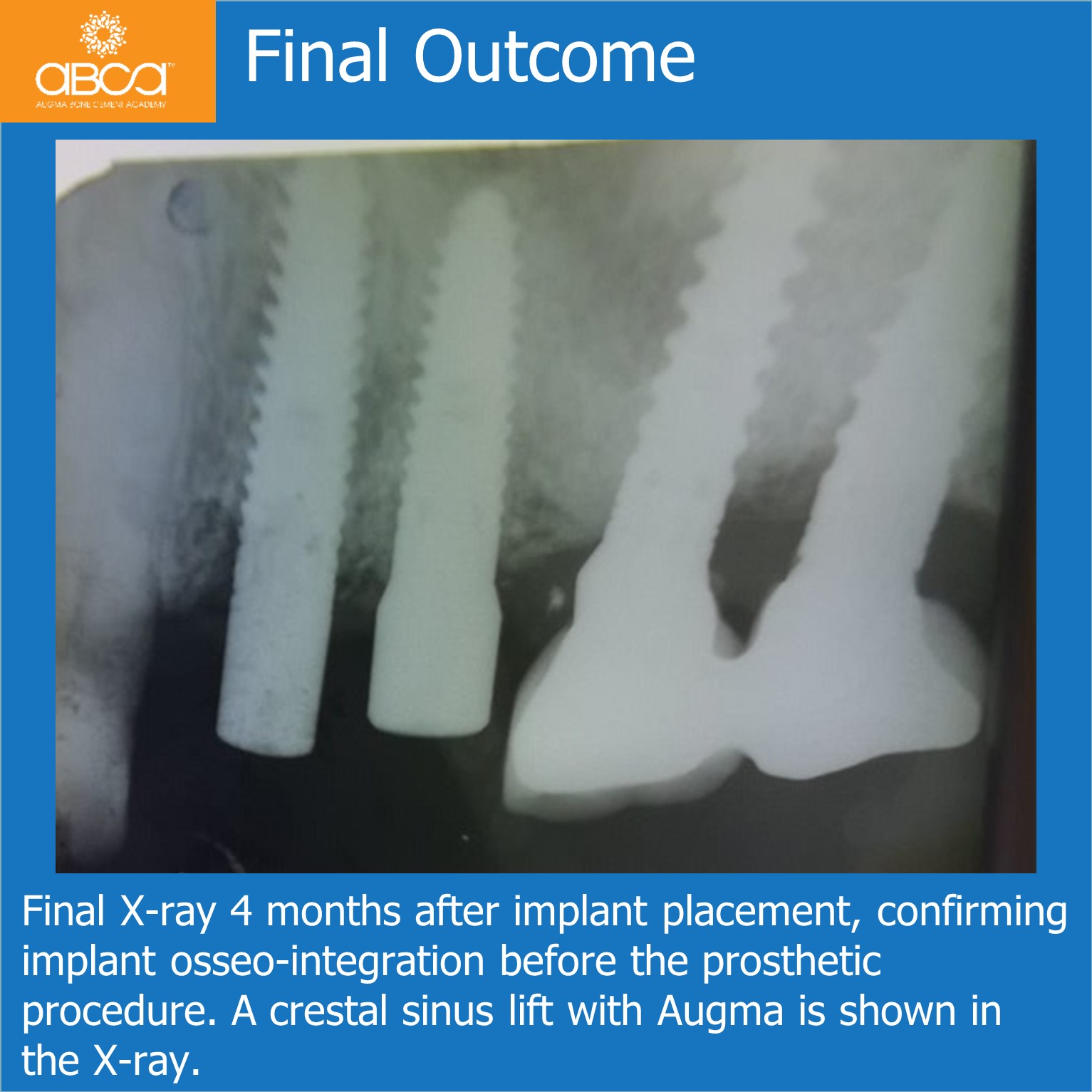 Final Outcome - Final X-ray 4 months after implant placement, confirming implant osseo-integration before the prosthetic procedure. A crestal sinus lift with Augma is shown in the X-ray