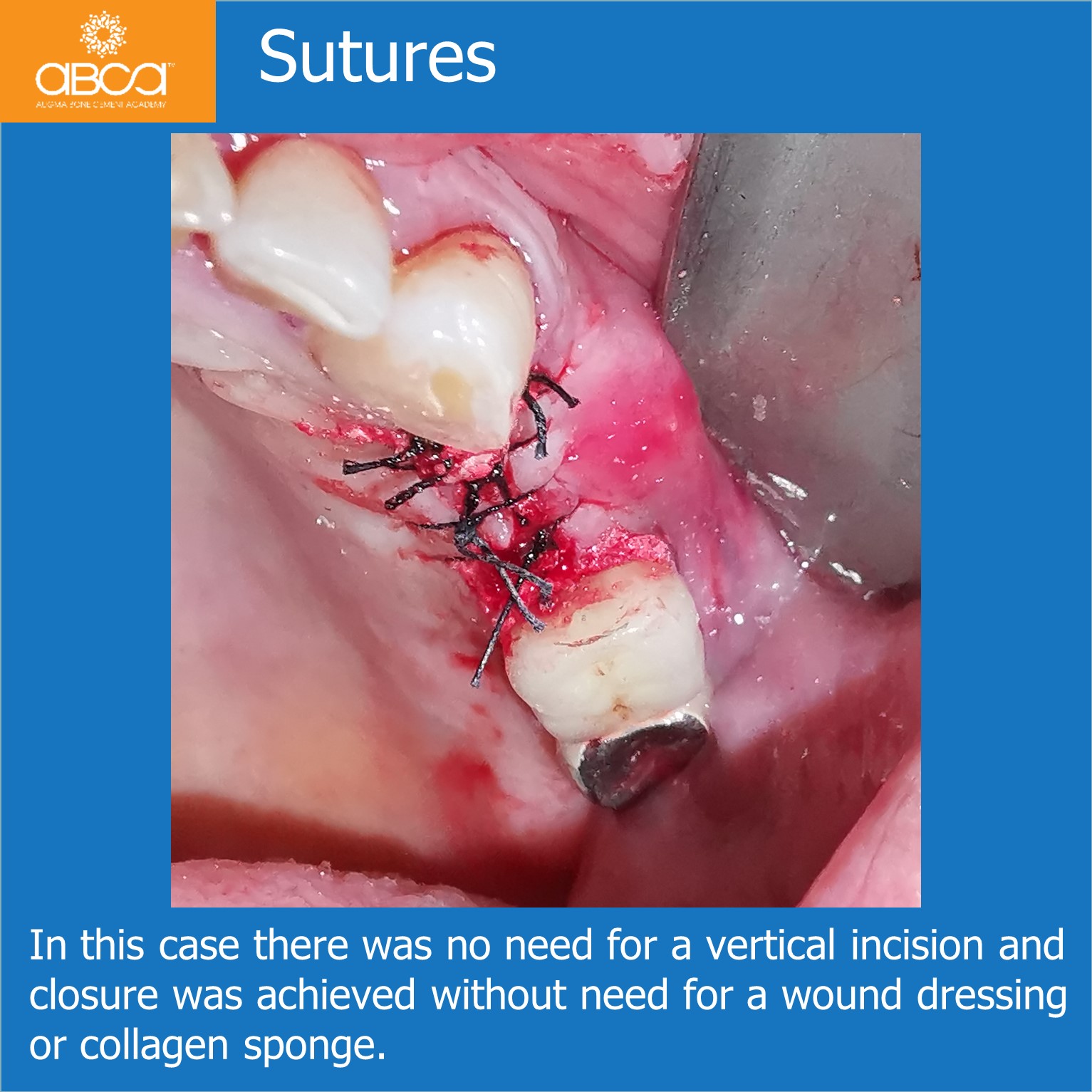 Sutures - In this case there was no need for a vertical incision and closure was achieved without need for a wound dress or collagen sponge