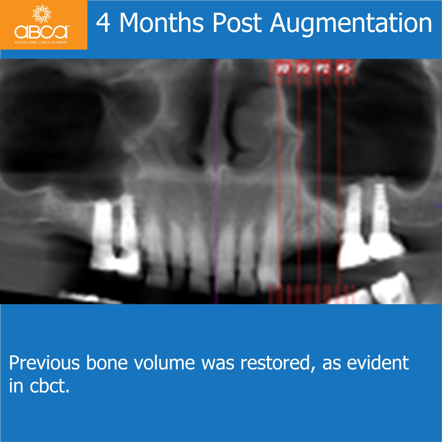 4 Months Post Augmentation - Previous bone volume was restored, as evident in cbct