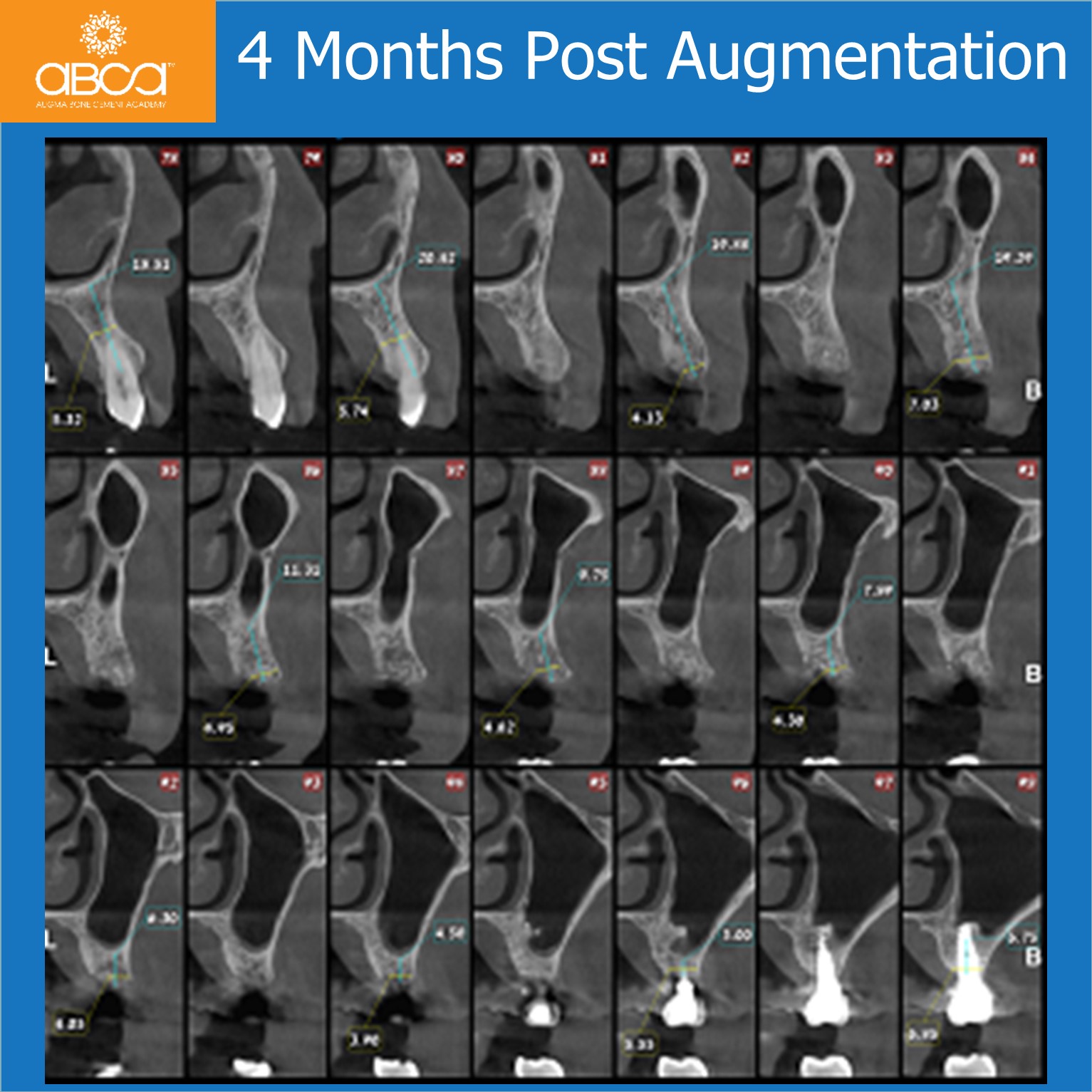 4 Months Post Augmentation Part I