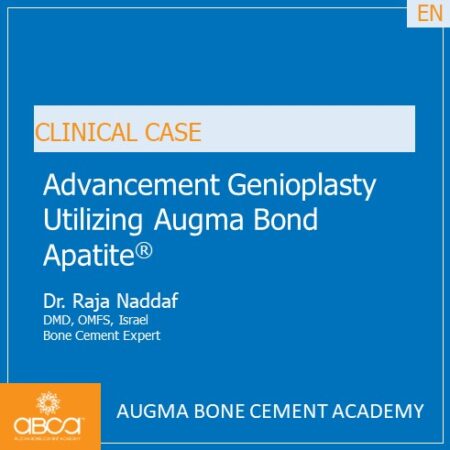 Advancement Genioplasty Utilizing Augma Bond ApatiteŽ