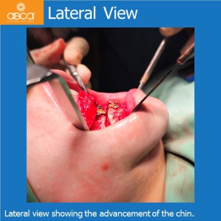 Advancement Genioplasty Utilizing Augma Bond ApatiteŽ